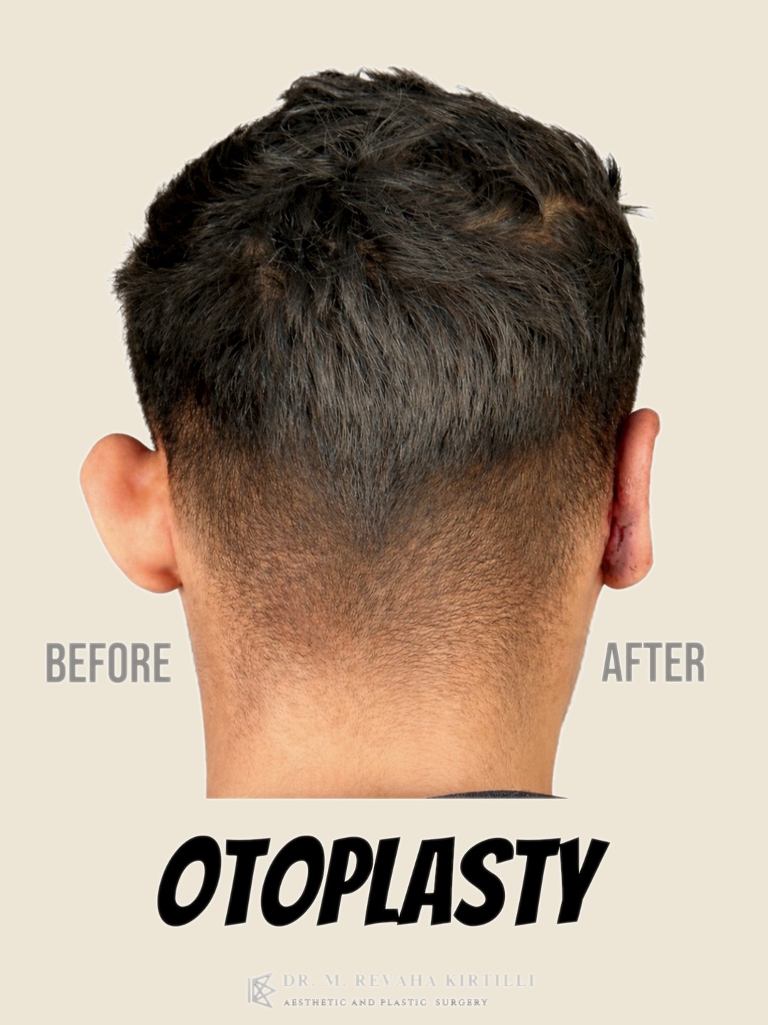 Confronto — Otoplastica — Orecchie a Sventola